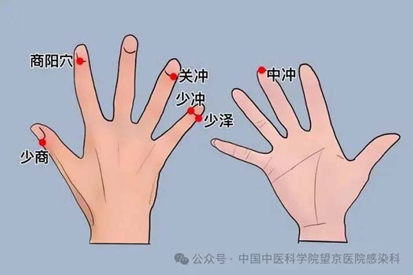 【望京︱科普】应对发热与“刀片嗓” —中医“井穴泄热放血法”有奇效